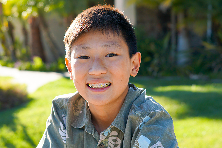 What Are Dental Sealants and Why Are They Important for Kids?